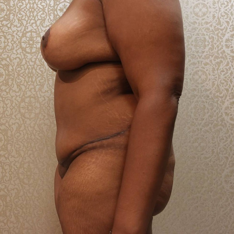 Tummy Tuck Before & After Image