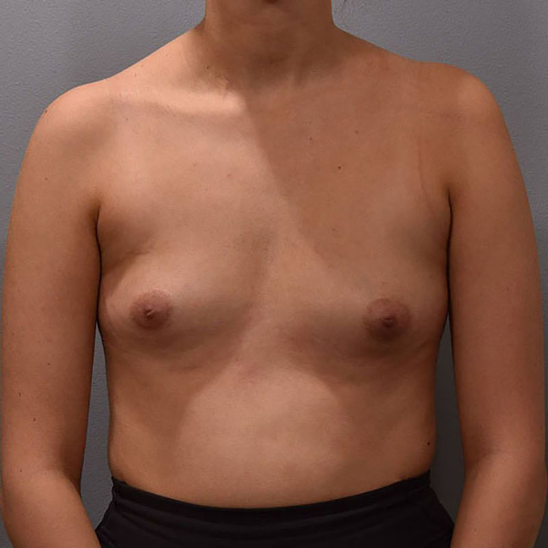 Breast Augmentation Before & After Image