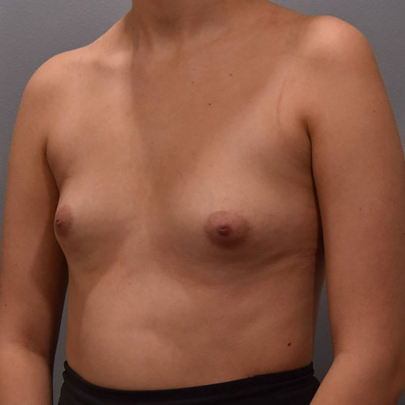 Breast Augmentation Before & After Image