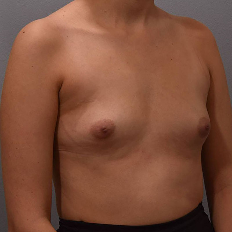 Breast Augmentation Before & After Image