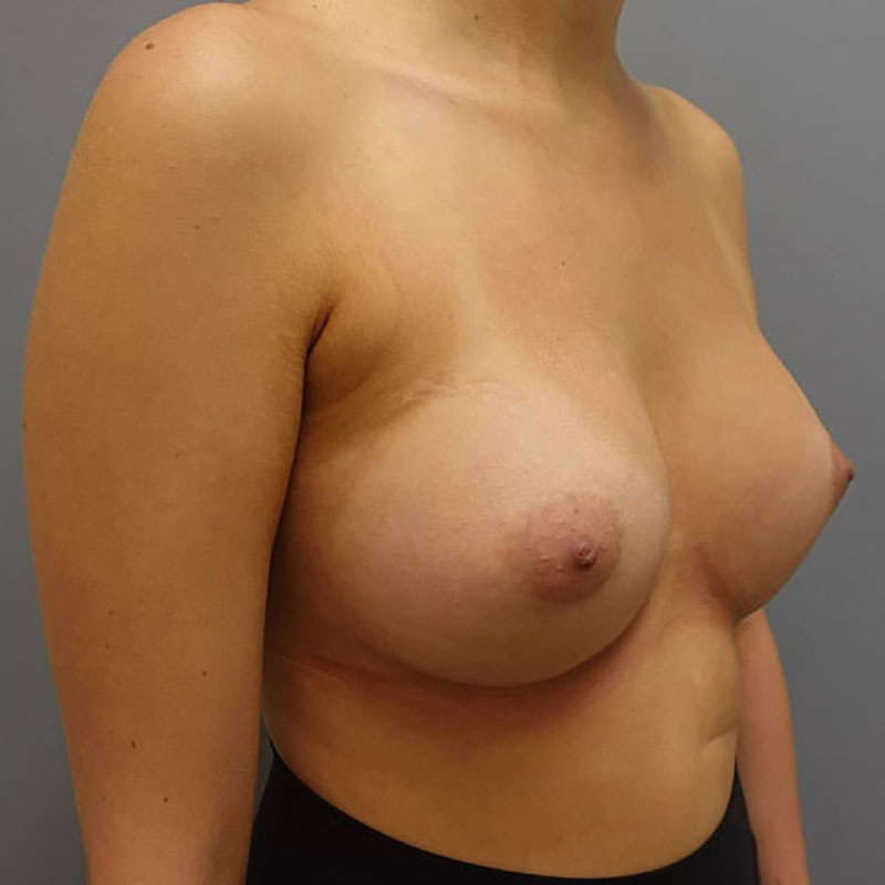 Breast Augmentation Before & After Image