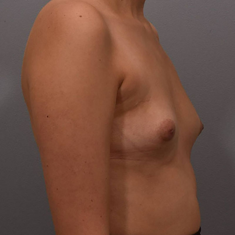 Breast Augmentation Before & After Image