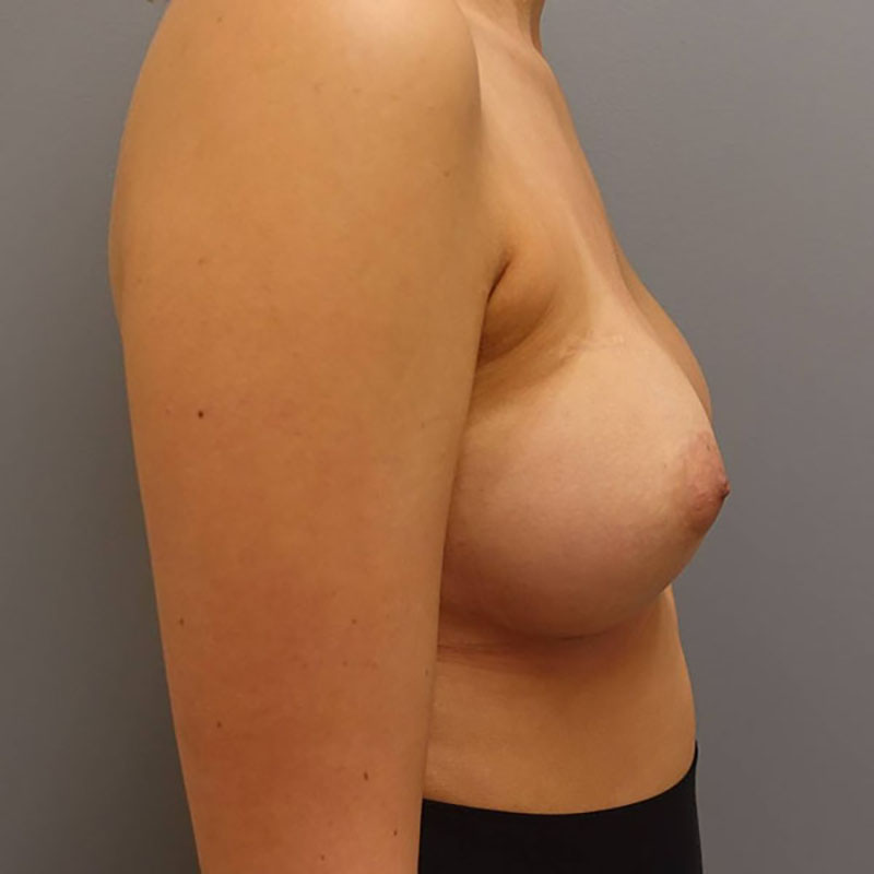 Breast Augmentation Before & After Image