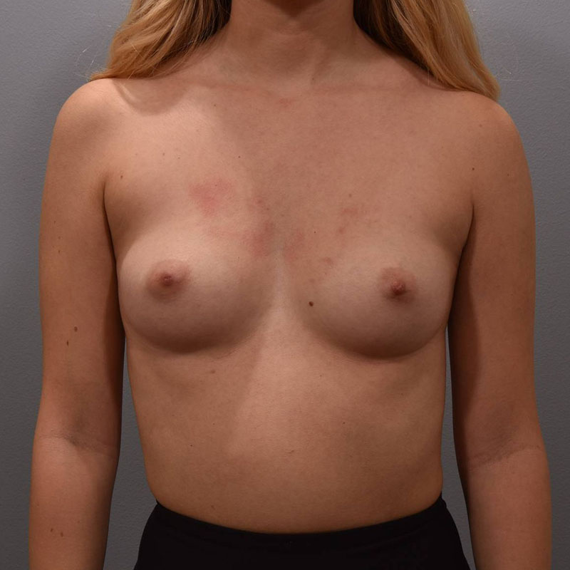 Breast Augmentation Before & After Image