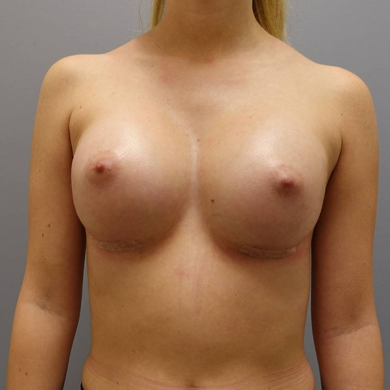 Breast Augmentation Before & After Image