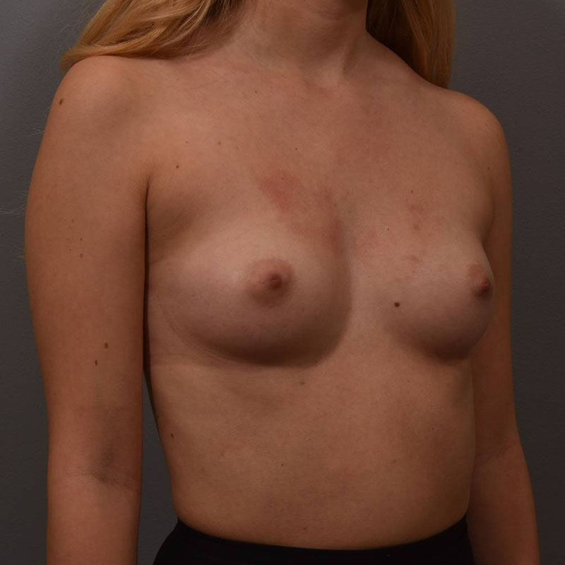 Breast Augmentation Before & After Image