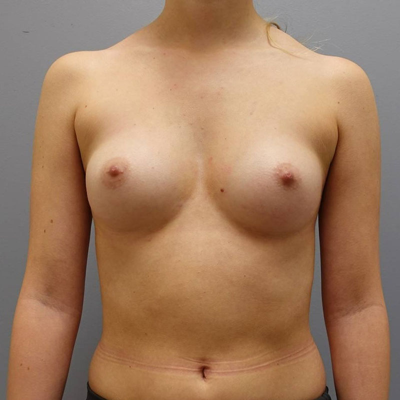 Breast Augmentation Before & After Image