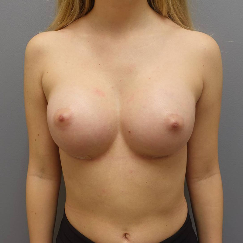 Breast Augmentation Before & After Image