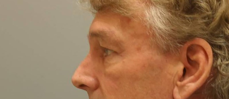 Blepharoplasty Before & After Image