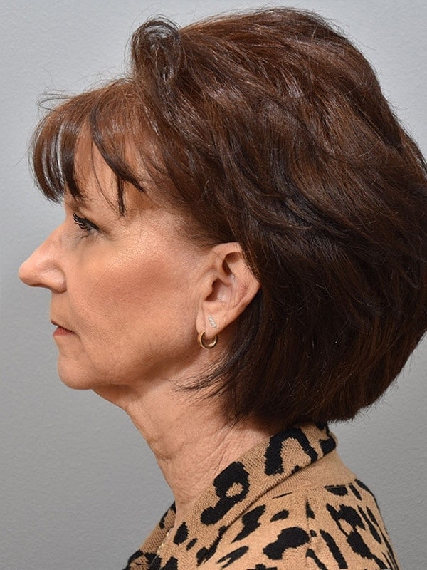 Face & Neck Lift Before & After Image