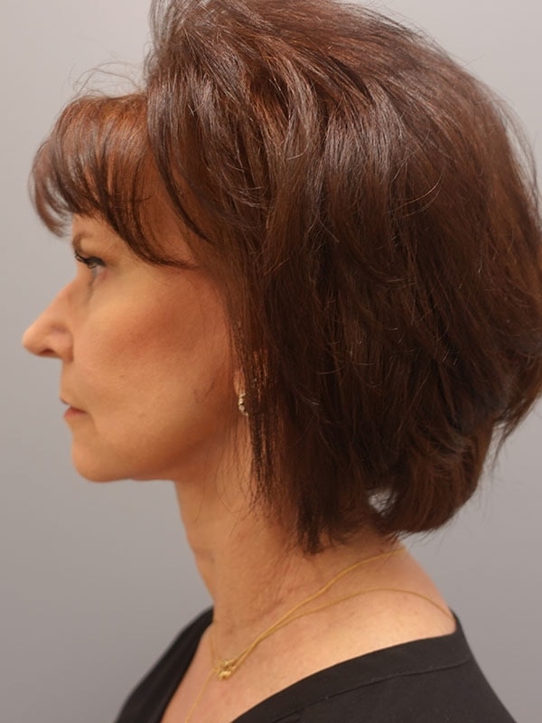 Face & Neck Lift Before & After Image