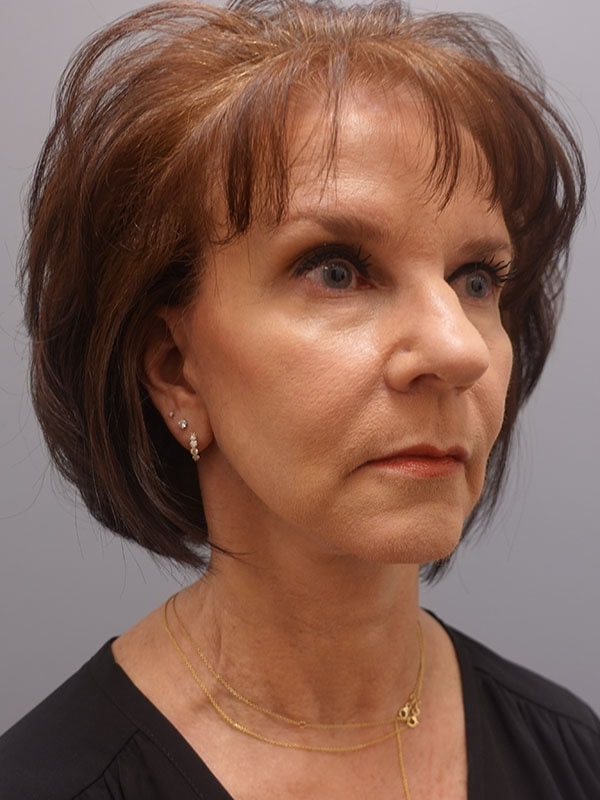 Face & Neck Lift Before & After Image