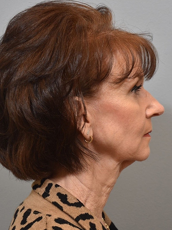 Face & Neck Lift Before & After Image