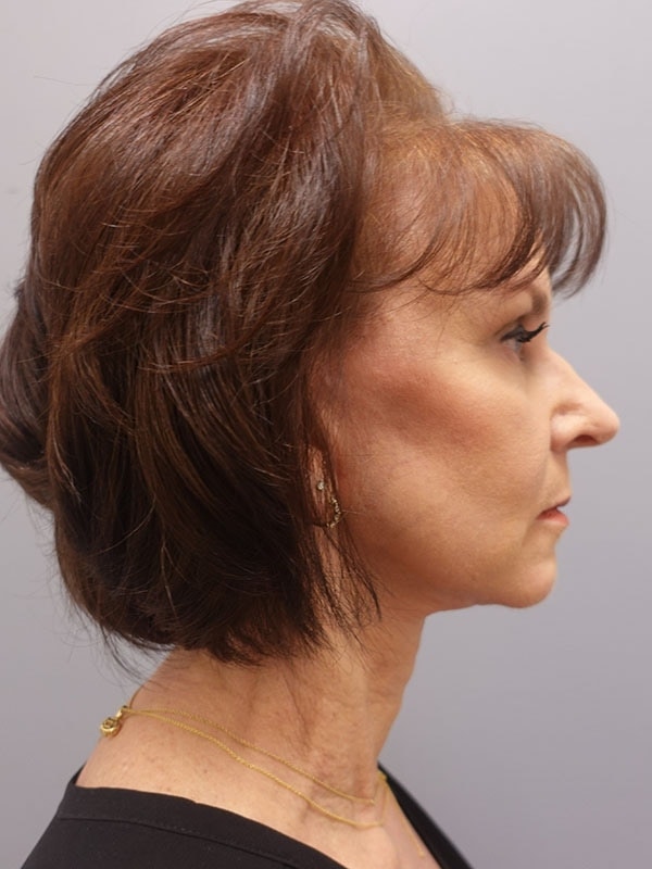 Face & Neck Lift Before & After Image