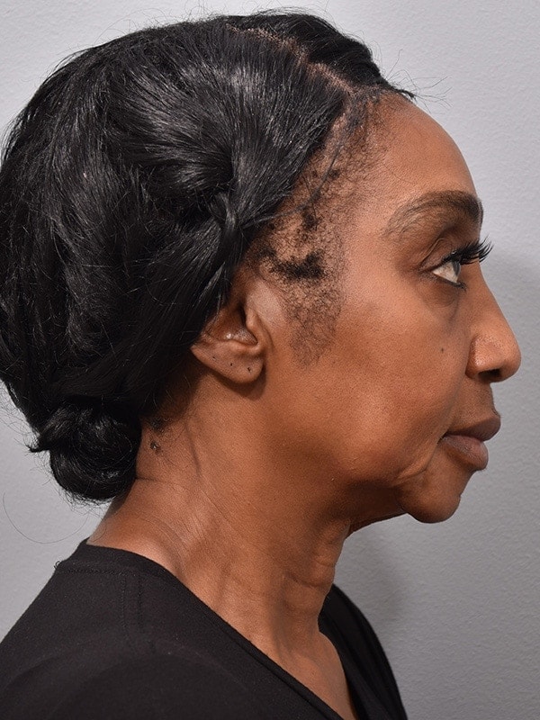 Face & Neck Lift Before & After Image