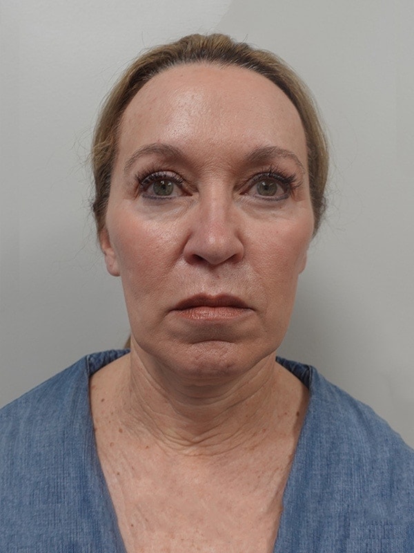 Face & Neck Lift Before & After Image