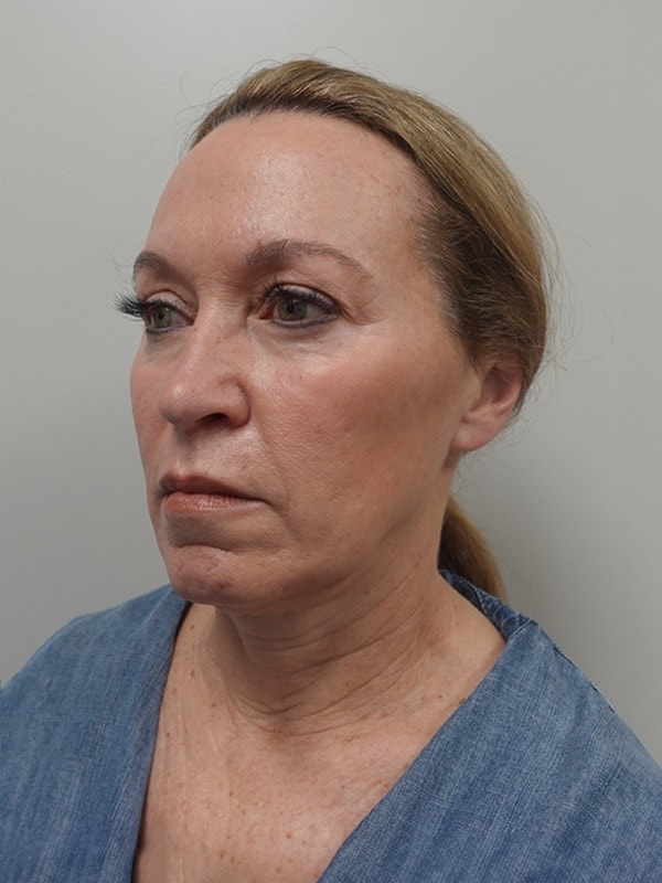 Face & Neck Lift Before & After Image