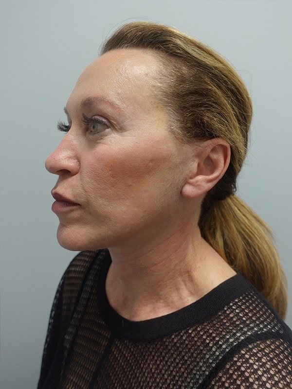 Face & Neck Lift Before & After Image