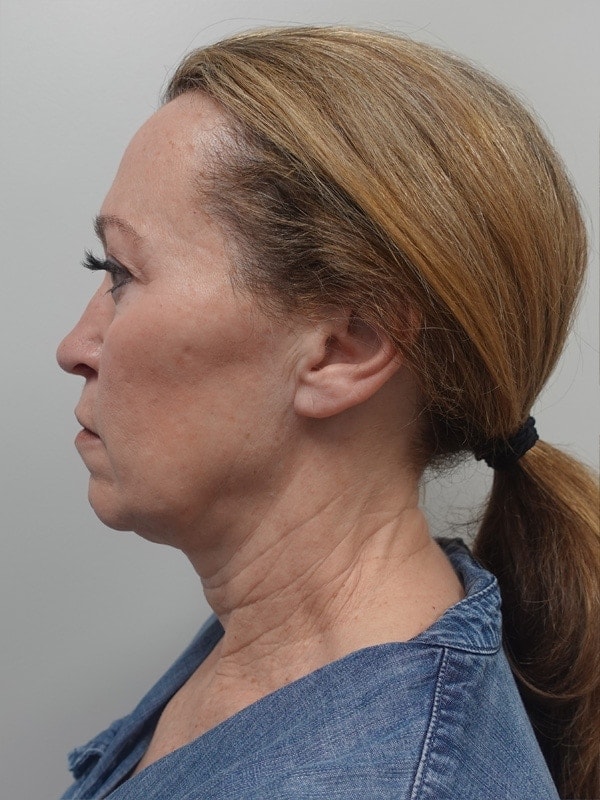 Face & Neck Lift Before & After Image