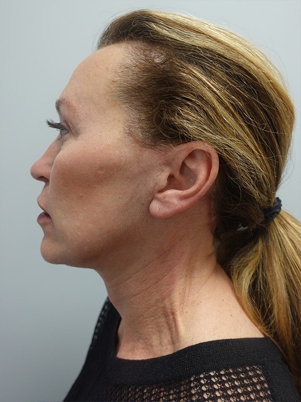 Face & Neck Lift Before & After Image