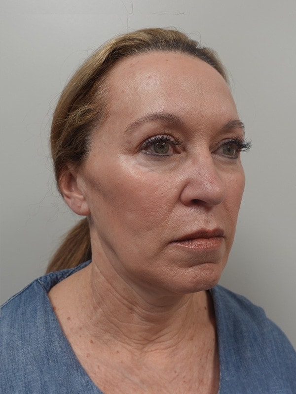 Face & Neck Lift Before & After Image