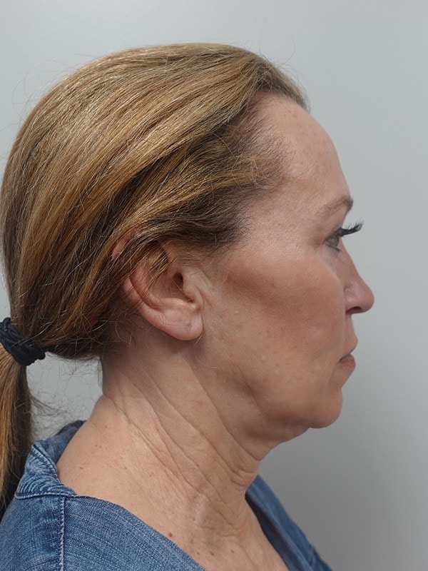 Face & Neck Lift Before & After Image