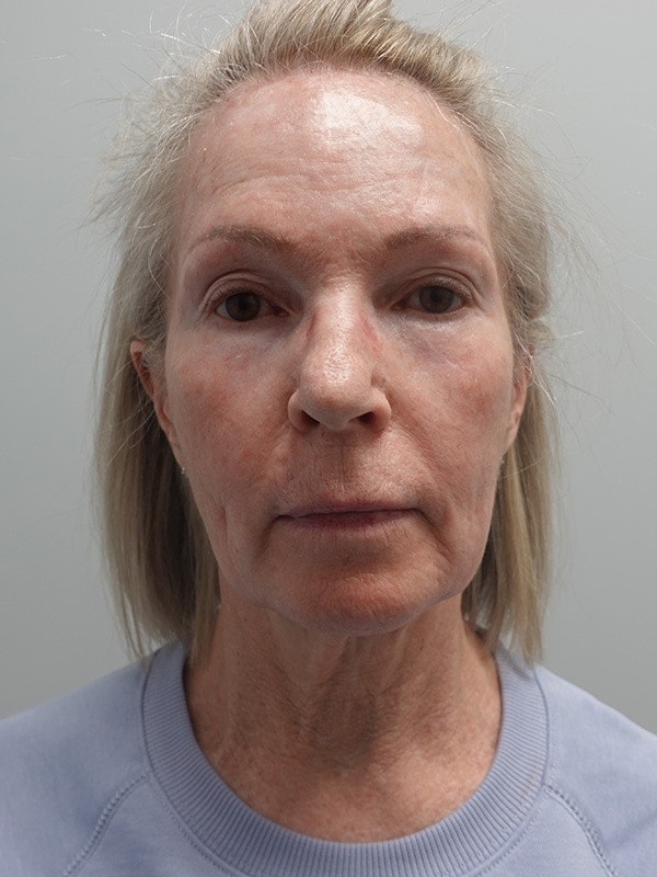 Face & Neck Lift Before & After Image