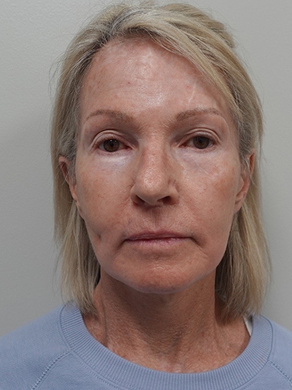 Face & Neck Lift Before & After Image