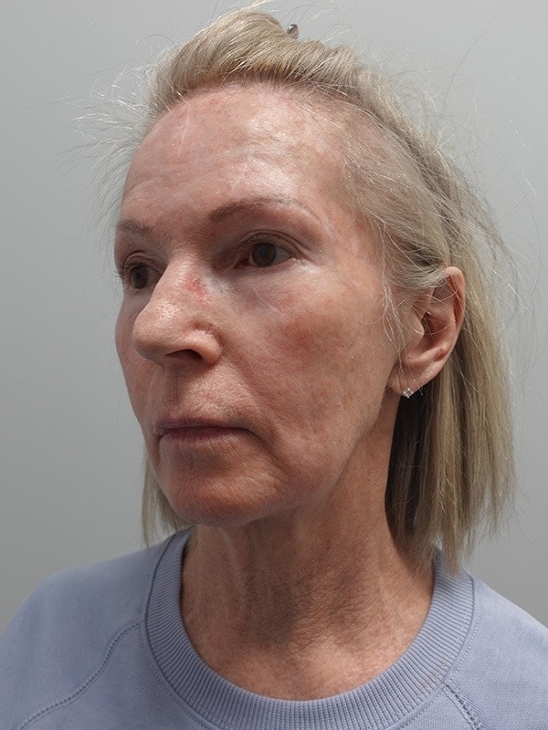 Face & Neck Lift Before & After Image