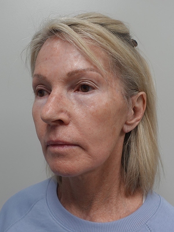 Face & Neck Lift Before & After Image