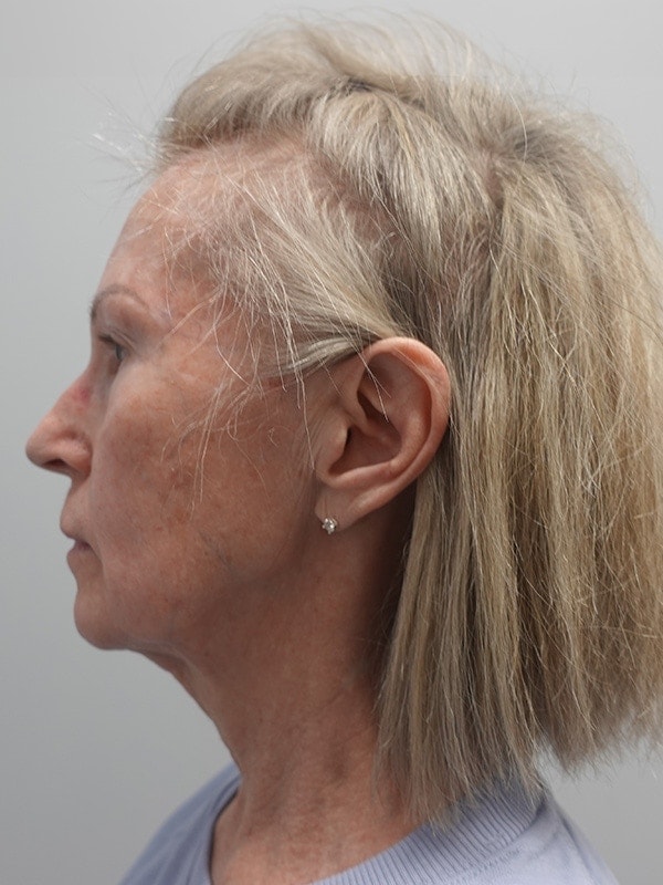 Face & Neck Lift Before & After Image