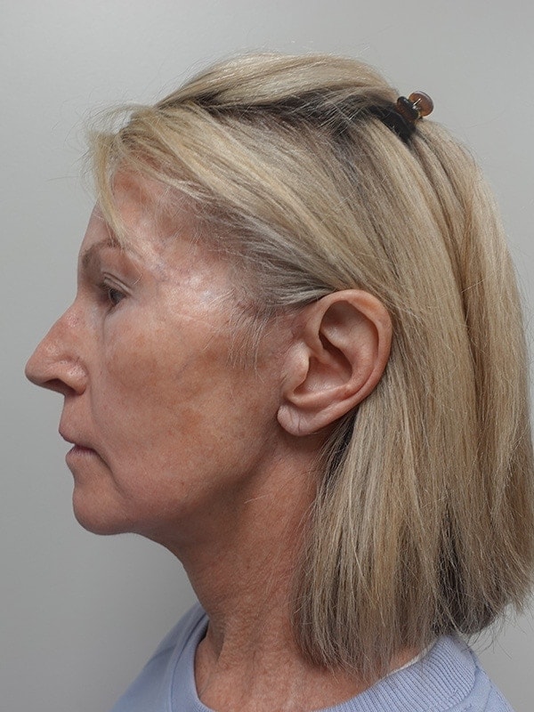 Face & Neck Lift Before & After Image