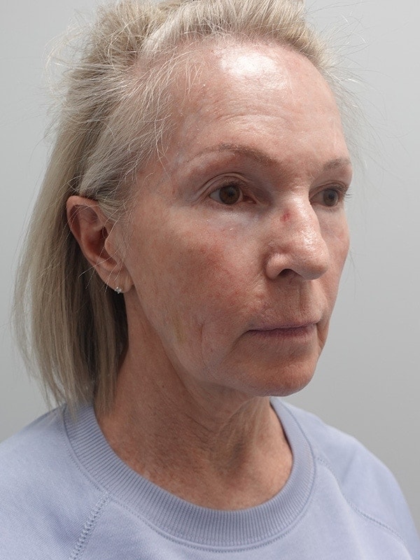 Face & Neck Lift Before & After Image