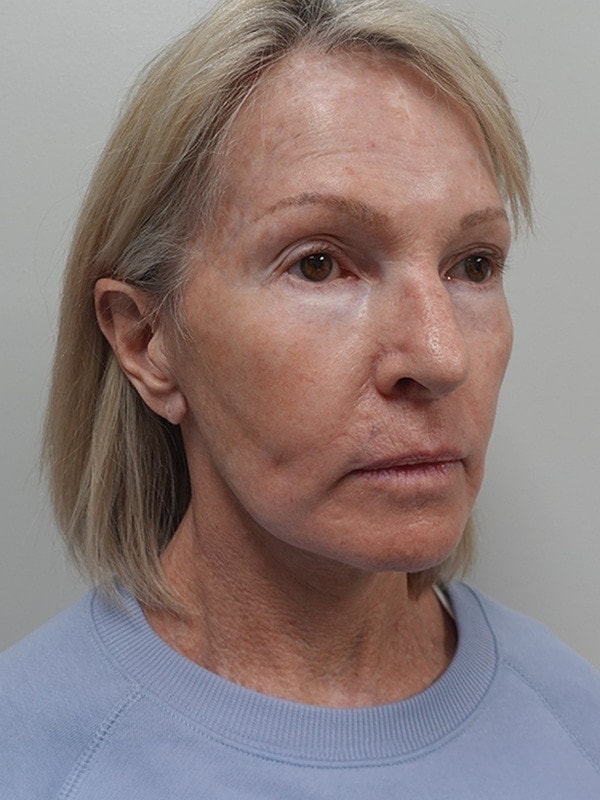 Face & Neck Lift Before & After Image