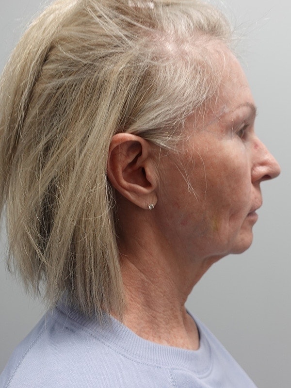 Face & Neck Lift Before & After Image