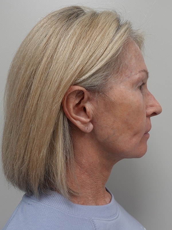 Face & Neck Lift Before & After Image