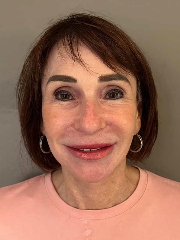 Face & Neck Lift Before & After Image