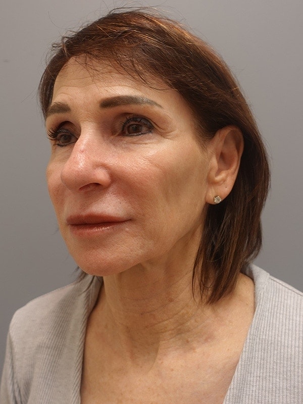 Face & Neck Lift Before & After Image