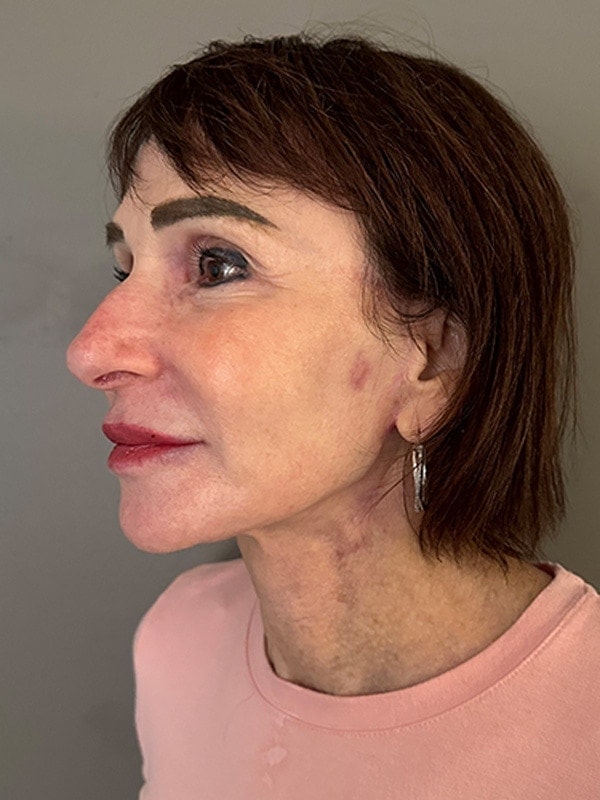 Face & Neck Lift Before & After Image