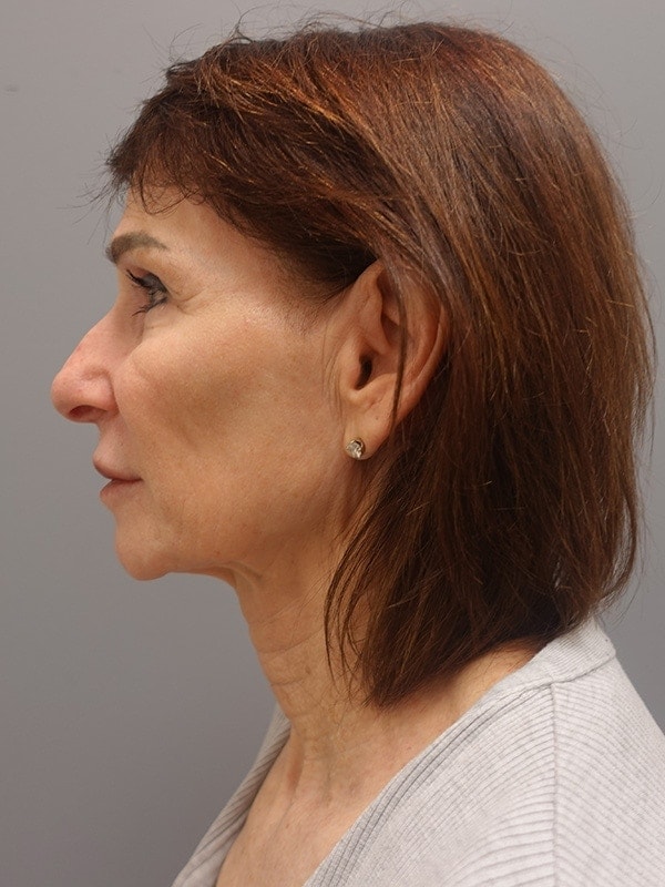 Face & Neck Lift Before & After Image