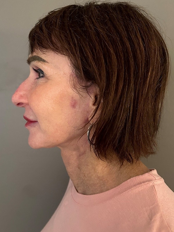 Face & Neck Lift Before & After Image