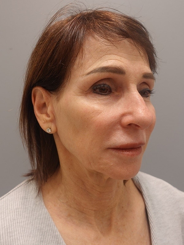 Face & Neck Lift Before & After Image