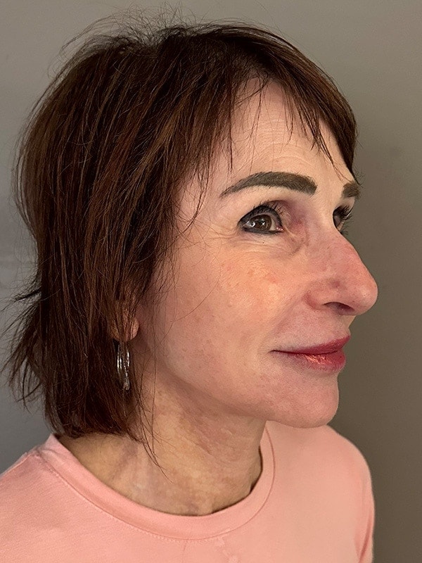 Face & Neck Lift Before & After Image