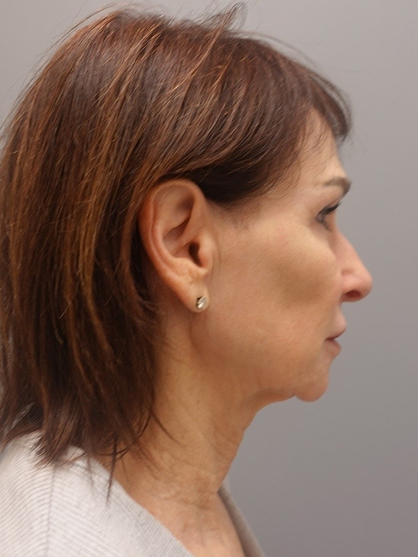 Face & Neck Lift Before & After Image