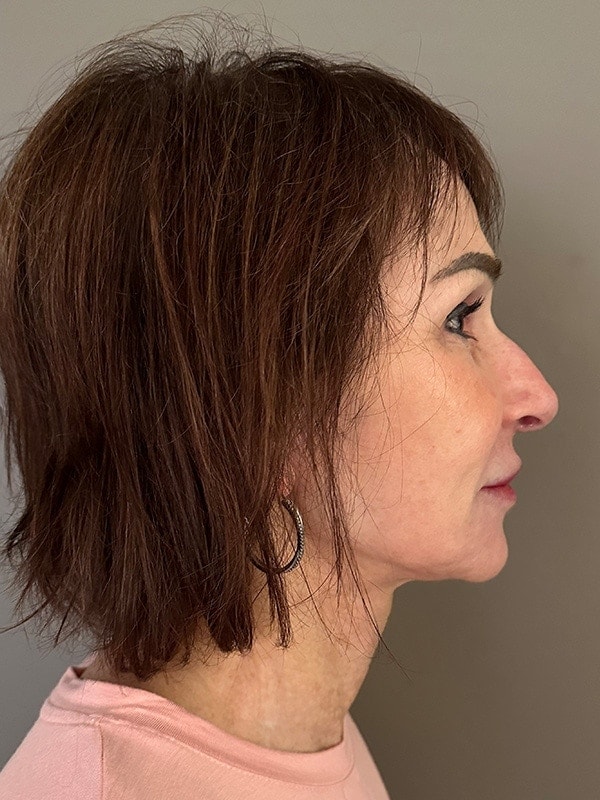 Face & Neck Lift Before & After Image